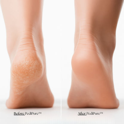 PediPure™ Callus Remover
